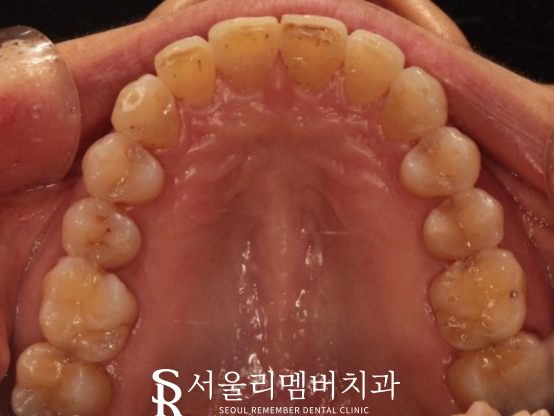 40대 교정 지금 시작해도 늦지 않을까요? 서울대입구역 치과 관련 이미지 13