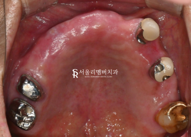 서울대입구역치과 수면마취를 사용한 전체 임플란트 식립 과정 관련 이미지 2