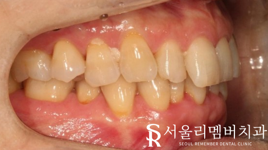 40대 교정 지금 시작해도 늦지 않을까요? 서울대입구역 치과 관련 이미지 3