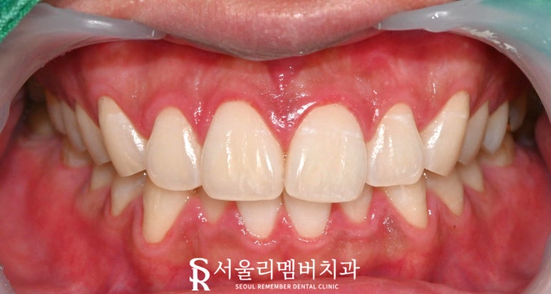 신대방 치과 치아미백 잘하는 곳 추천, 오래 유지하려면 어떻게 해야 되나요? 관련 이미지 4