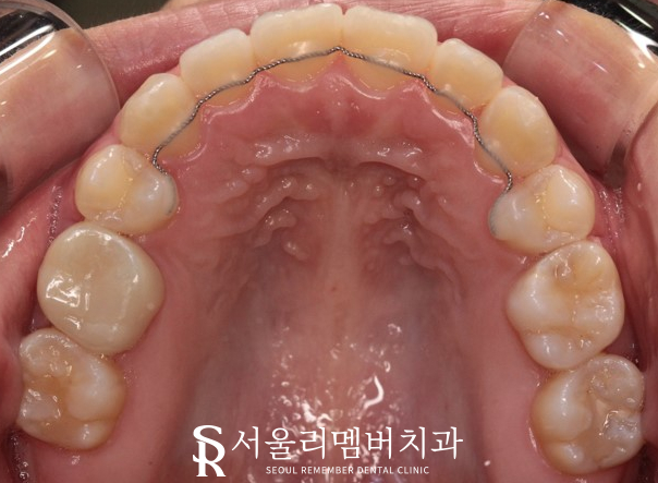 서울대입구역 치과 툭 튀어나온 돌출 때문에 발치교정 진행 관련 이미지 9