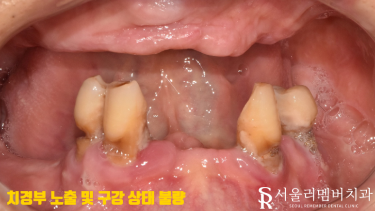 오랜 틀니 착용으로 잇몸이 다 망가졌던 분.. 임플란트 식립으로 밝은 미소 되찾아드렸습니다! 서울대입구역 서울 리멤버 치과 관련 이미지 2