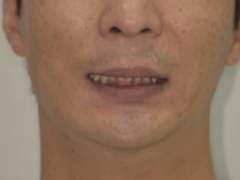 임플란트와 치아교정, 동시에 치료받을 수 있을까요? 남성역 서울 리멤버 치과 관련 이미지 10