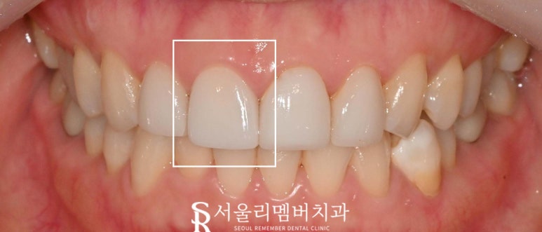 서울대입구역 치과, 깨진 앞니 라미네이트 한 개만 교체 치료 가능할까요? 관련 이미지 4