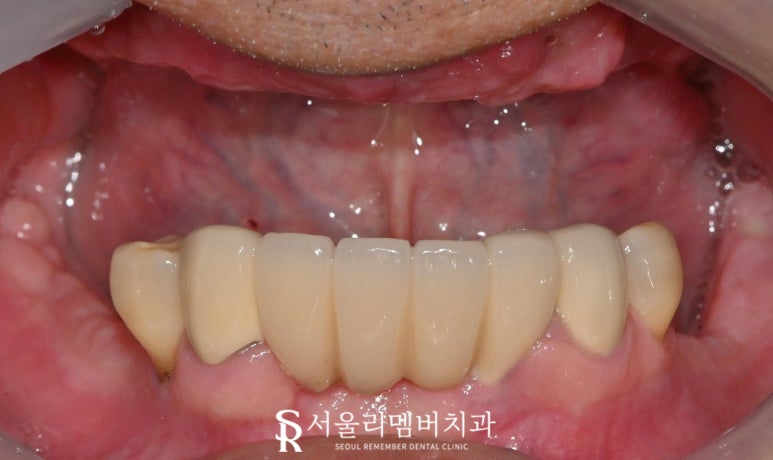 과잉진료 없는 보라매 치과 에서 최소 개수 전악 임플란트 식립 관련 이미지 4