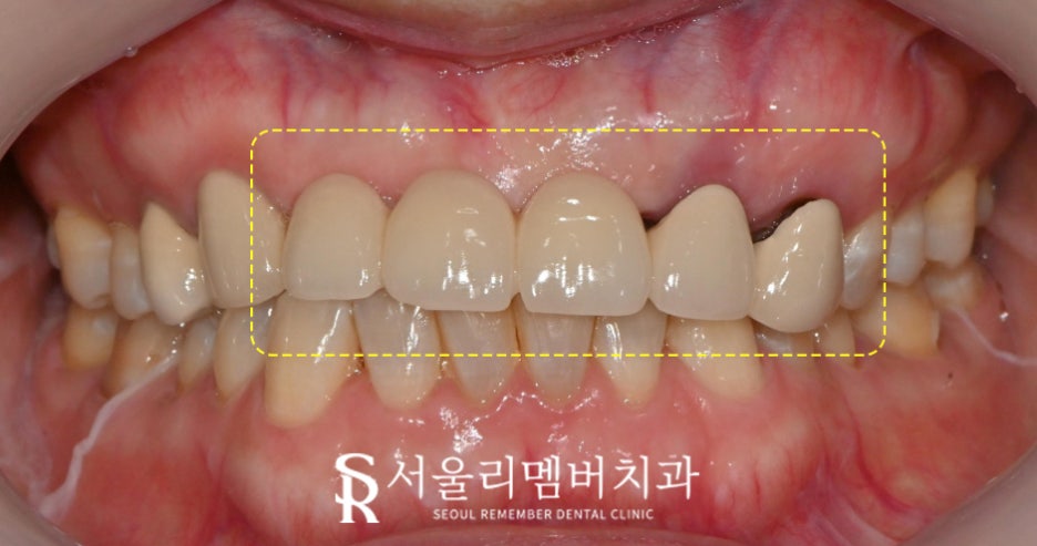 상악 전치부 임플란트 후 고퀄리티 심미보철 로 자신감 되찾으세요! 관련 이미지 2