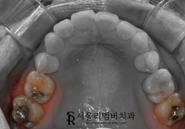 숭실대입구역 치과 에서 이차우식이 생긴 오래된 인레이를 새하얗게 개선해 드렸습니다. 관련 이미지 1