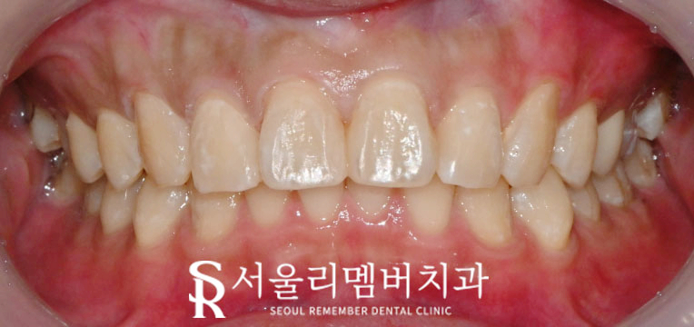 앞니 충치, 서울대입구역 치과 에서 당일 레진 치료로 빠르게 환한 웃음 되찾으세요! 관련 이미지 3