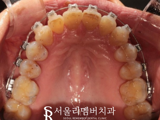 40대 교정 지금 시작해도 늦지 않을까요? 서울대입구역 치과 관련 이미지 8