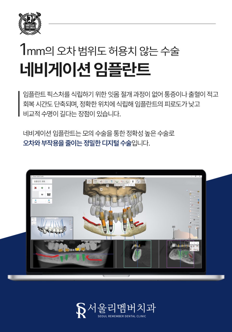 청림동 서울 리멤버 치과 에서 알려드리는 임플란트 나사 풀림 원인과 대처법 관련 이미지 3