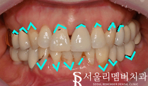 서울대입구역 치과 치경부 마모증 때문에 잇몸 패임 레진치료로 깔끔하게! 관련 이미지 2