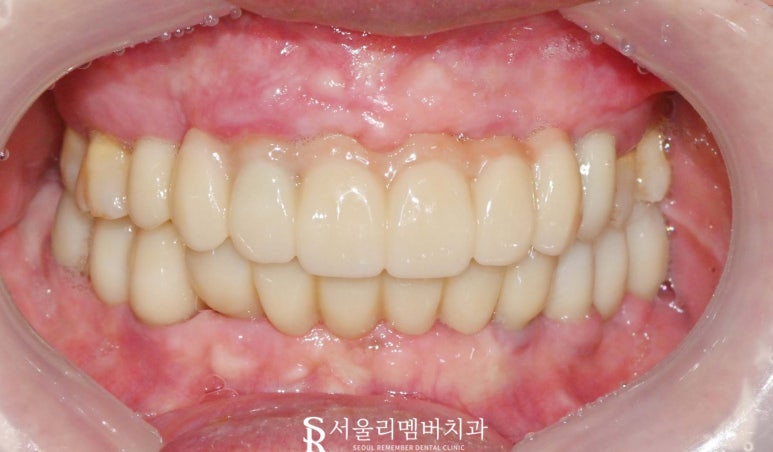 신림역 치과 "틀니는 쓰기 싫어요." 전체 임플란트 식립 후기 관련 이미지 6