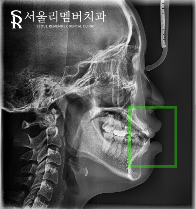 서울대입구역 치과 툭 튀어나온 돌출 때문에 발치교정 진행 관련 이미지 4
