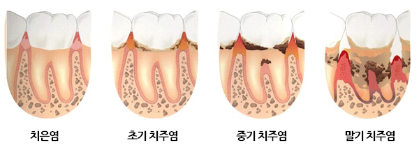 서울대입구역 치과 에서 알려드리는 치주 질환(풍치)의 위험성. 관련 이미지 2