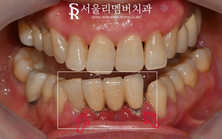 Loose Lower Front Teeth, Sillim Station Dental Clinic, Insurance Anssurge Implant for Patients 65 and Older, Minimal Placement, Lower Cost, Faster Completion image 2