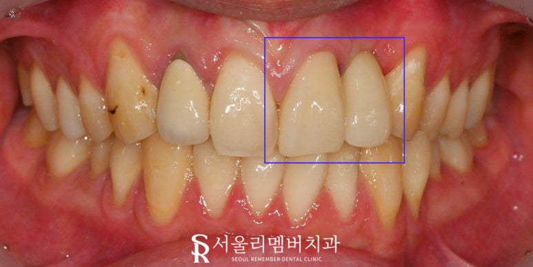 신대방 치과 앞니 충치와 약해진 치아 신경치료 크라운 및 부러진 측절치 발치 임플란트 관련 이미지 2