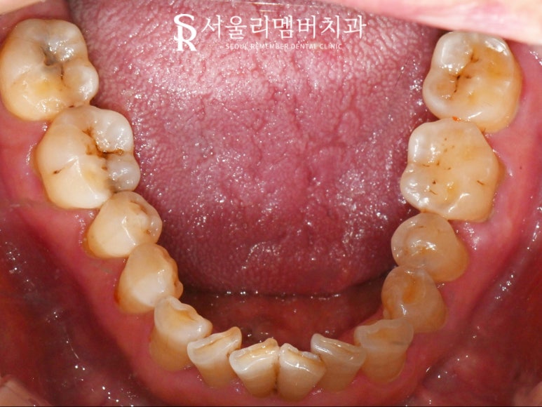 서울대입구역 치과 임플란트, 신경치료 크라운, 인레이 모두 해야 된다면 어떤 진료부터 시작해야 될까요? 관련 이미지 2