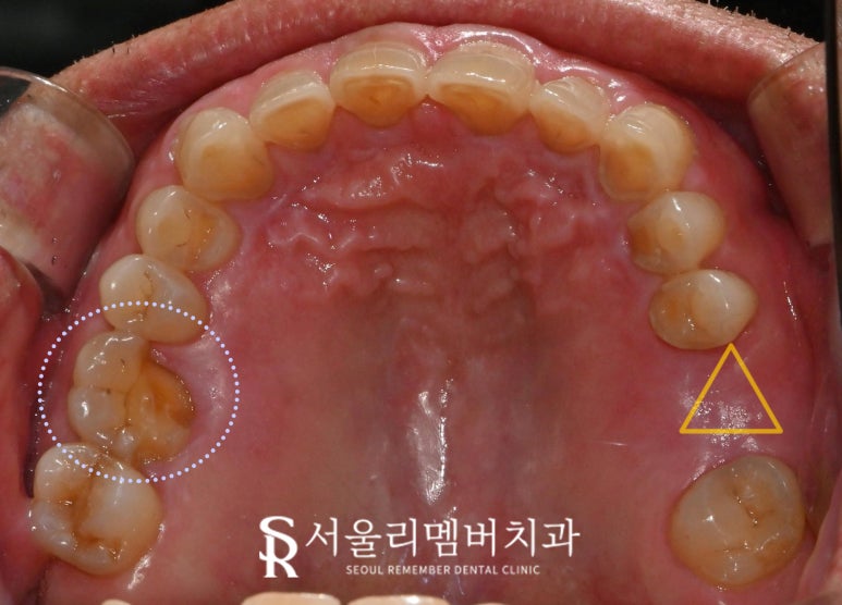 서울대입구역 치과 어금니 상실로 무너진 수직 고경과 과개 교합, 신경치료 크라운과 임플란트로 개선할 수 있다면 관련 이미지 3