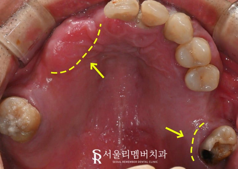 "도저히 음식을 먹지 못해요" 봉천역 치과 수면 임플란트 치료 사례 관련 이미지 2