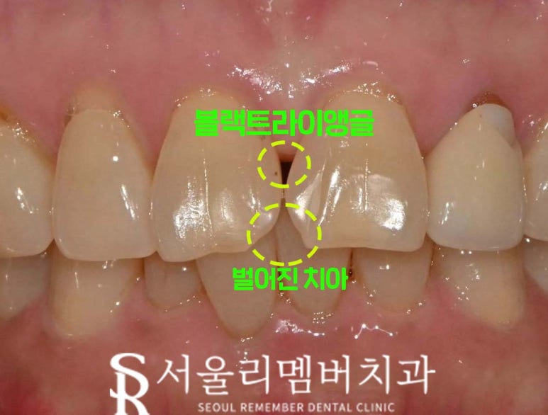 서울대입구역 치과, 벌어진 치아를 당일에 치료하는 방법. 정중이개 레진 수복 관련 이미지 1