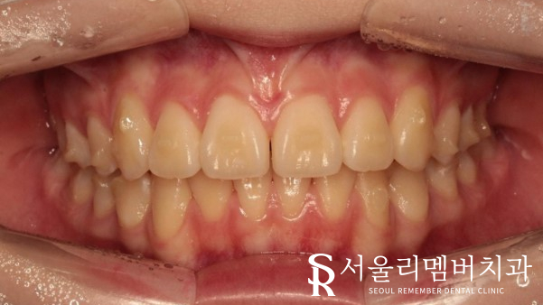 인비절라인을 사용한 치아 총생 개선 증례! 청룡동 치과 관련 이미지 7