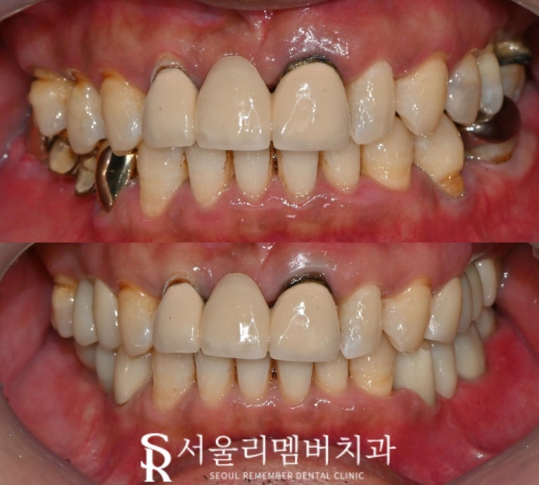 한 번에 많은 치아 치료해야 된다면? 사당역 치과 수면 임플란트 로 편안하게 관련 이미지 1