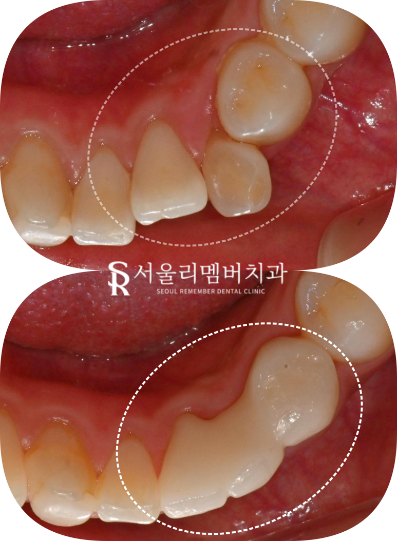 서울대입구역 치과 선천적 영구치 결손으로 잔존 유치 발치 후 브릿지 수복 케이스 관련 이미지 5