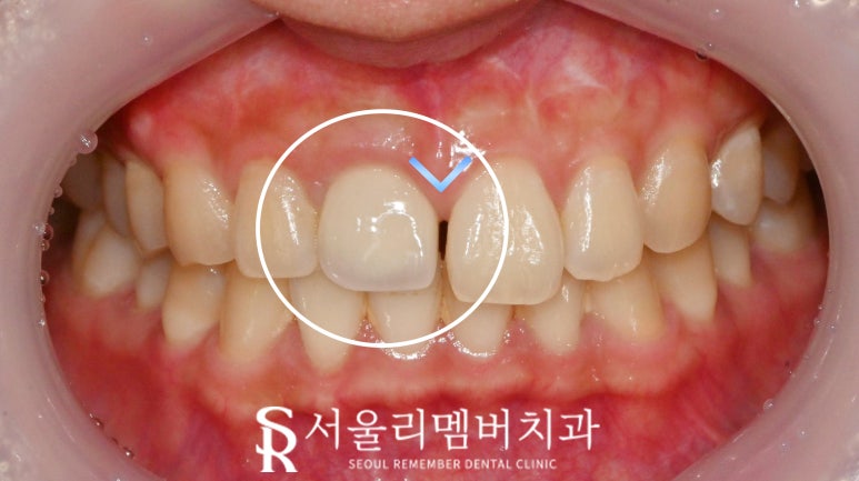 서울대입구역 치과 앞니 임플란트 보철 디자인 생김새 모양 마음에 안 들 때 수정할 수 있을까? 관련 이미지 1