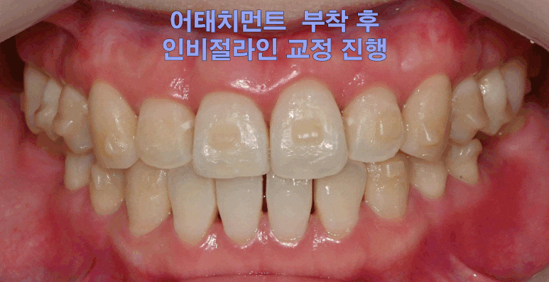 선천적 영구치 결손으로 남아있는 만기 잔존 유치, 서울대입구역 교정 치과 에서 투명 인비절라인 & 임플란트 케이스 관련 이미지 5