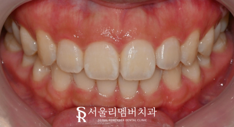 MZ 세대 인기 만점 투스잼(Tooth Gem), 어떻게 붙이고 어떻게 제거할까요? 서울대입구치과 관련 이미지 3