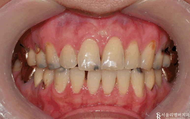 곳곳에 많은 충치, 신림역 치과 에서 앞니 심미 레진 치료와 어금니 지르코니아 크라운 치료 관련 이미지 3