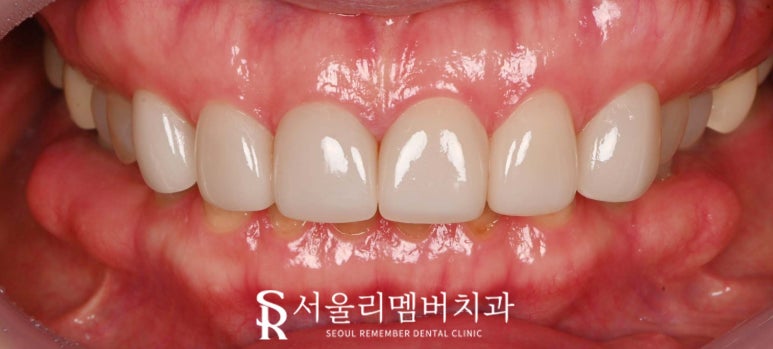 상도동 치과 누렇게 보이는 앞니 6전치 심미보철 라미 리얼네이트로 밝고 자연스럽게 개선한 사례 관련 이미지 5