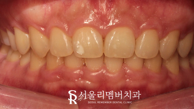 과개교합, 외적인 문제는 물론이며 기능 회복까지 개선하는 것이 중요합니다. 신대방치과 치아교정 관련 이미지 6