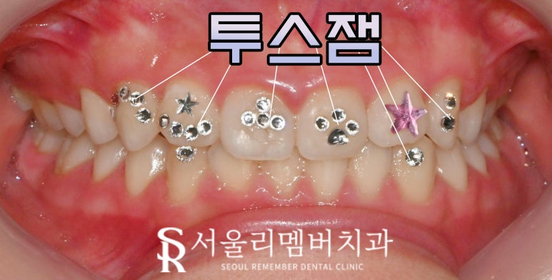 서울대입구역 치과 투스잼 제거 꼭 전문가에게 해야 되는 이유와 관리 방법 관련 이미지 1