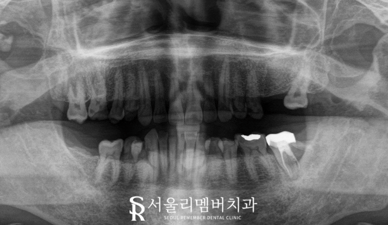 서울대입구역 치과 어금니 상실로 무너진 수직 고경과 과개 교합, 신경치료 크라운과 임플란트로 개선할 수 있다면 관련 이미지 1