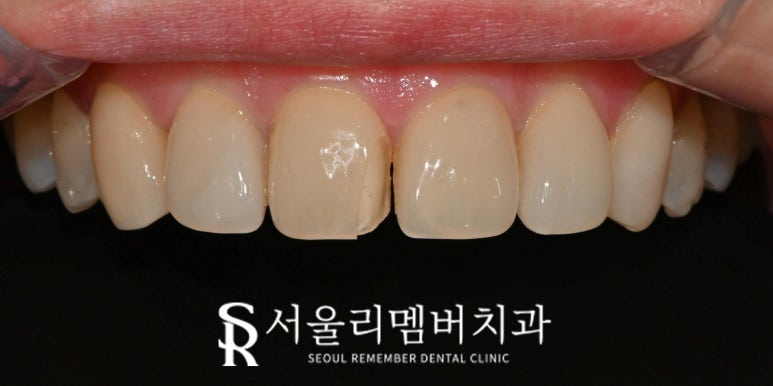 봉천역 치과 파절된 앞니 크라운, 6전치 라미네이트로 심미성 회복하고 환한 미소 되찾기 관련 이미지 1