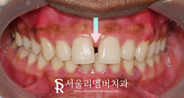 신림 치과 벌어진 앞니 정중이개 다이아스태마 레진 당일 충전 치료 관련 이미지 1