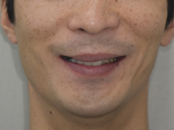 임플란트와 치아교정, 동시에 치료받을 수 있을까요? 남성역 서울 리멤버 치과 관련 이미지 11