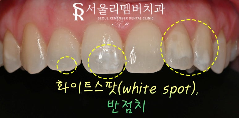 앞니에 생긴 하얀 점? 신림 치과 전치부 화이트스팟(white spot) 레진 당일 치료 관련 이미지 2