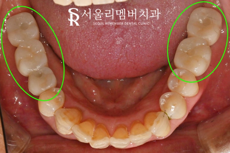 해외 거주하는 한국인, 임플란트 치료는 국내에서 받고 싶다면? 상도동 치과 수술 계획 및 과정 관련 이미지 8
