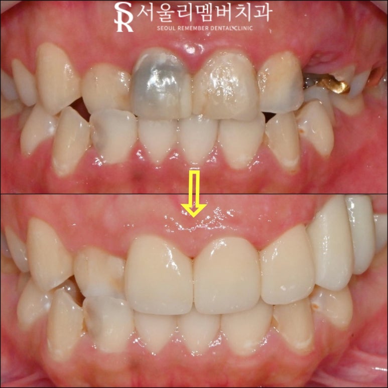 신대방 치과 "처음에는 작은 충치, 나중에는 치아 발치?" 앞니 임플란트 및 신경치료 후기 관련 이미지 5
