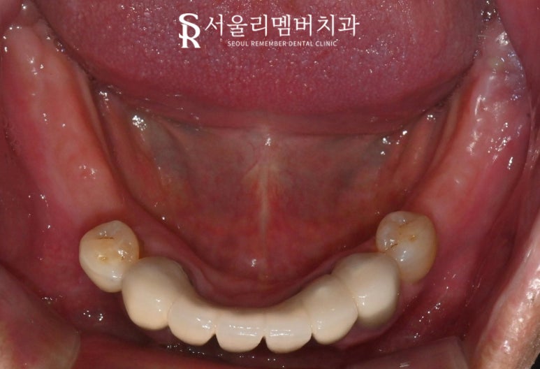 과잉진료 없는 보라매 치과 에서 최소 개수 전악 임플란트 식립 관련 이미지 2