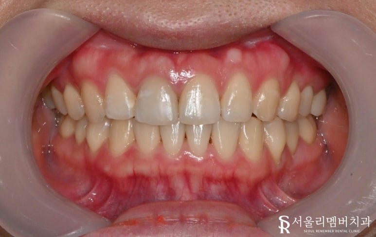 A “Pop-Out” Tooth, Cavities in the Front Teeth and Molars: Orthodontic and Cavity Treatment at a Sindae-bang Dental Clinic image 5