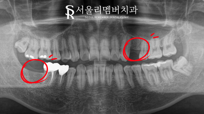 치아 상실로 내원해주셨던 분, 트라우마 극복 후 임플란트 식립 신길동 치과 관련 이미지 1