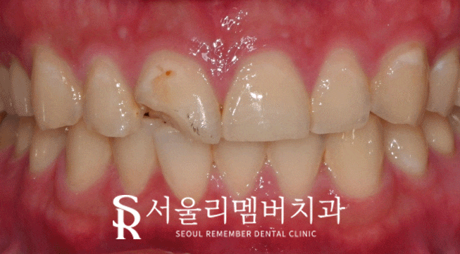 사당동 치과 에서 외상으로 인한 앞니 파절, 심미보철로 개선해 드렸습니다. 관련 이미지 4