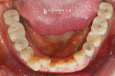 봉천동 치과 상실된 치아 방치하면 안 되는 이유 (feat.임플란트 브릿지 보철치료) 관련 이미지 9