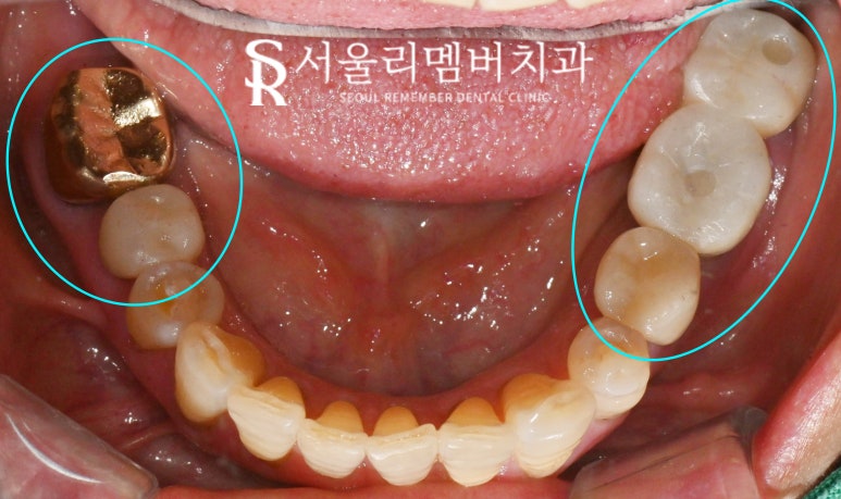 잇몸뼈 녹아버린 치아, 발치 후 그다음은? 사당역 치과 임플란트 관련 이미지 6