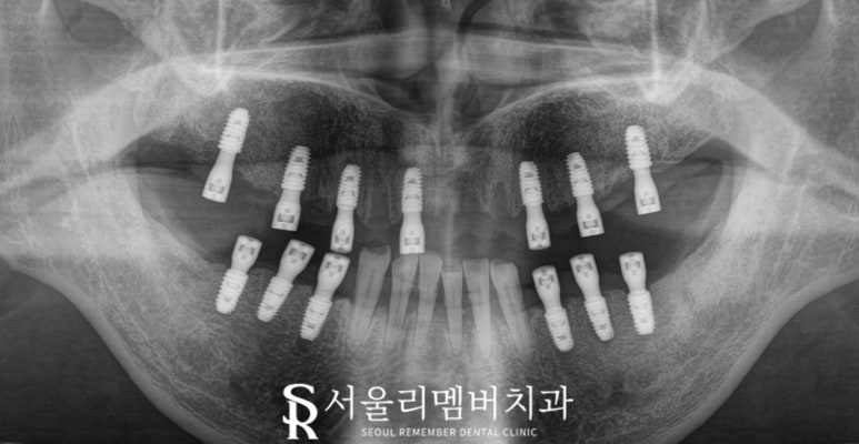 사당 치과 하악 전치 신경치료 브릿지로 살리고 나머지 임플란트로 재건한 전악 증례 관련 이미지 8