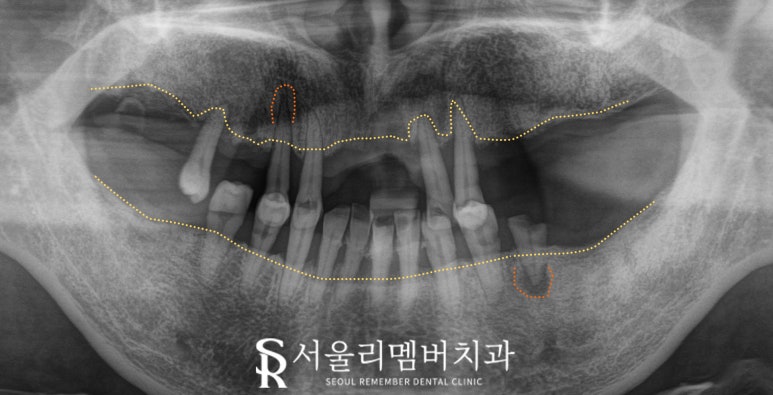 사당 치과 하악 전치 신경치료 브릿지로 살리고 나머지 임플란트로 재건한 전악 증례 관련 이미지 7