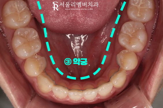 서울대입구역 치과 툭 튀어나온 돌출 때문에 발치교정 진행 관련 이미지 14
